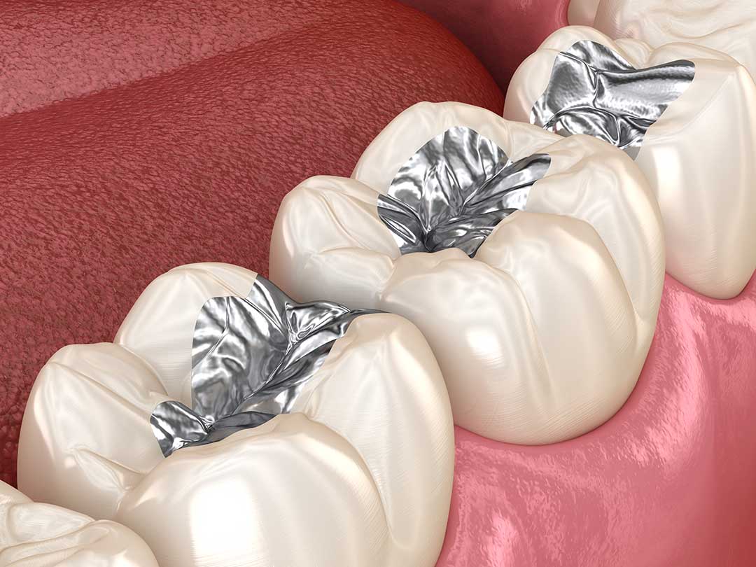 Dental Amalgam: When Is Replacement Necessary?