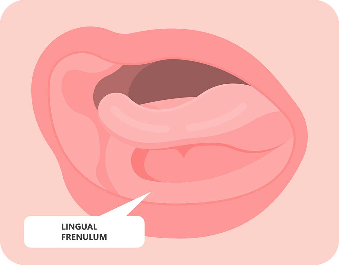 image of lingual frenectum