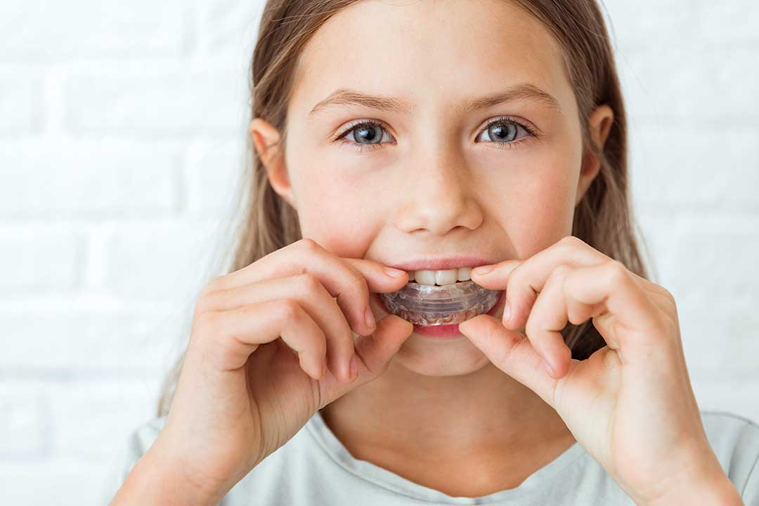 Myobrace for Children: A Natural Solution for Straight Teeth