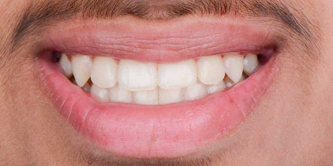 Close-up of a child's mouth after orthodontic treatment, showing a properly corrected underbite and aligned teeth.