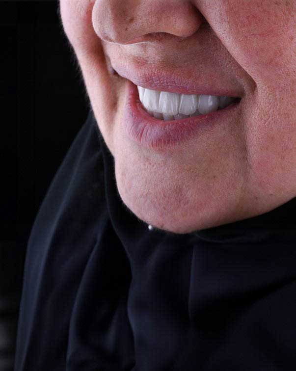 Close-up of a female patient's mouth at Harmony Medical Center after dental implant treatment.