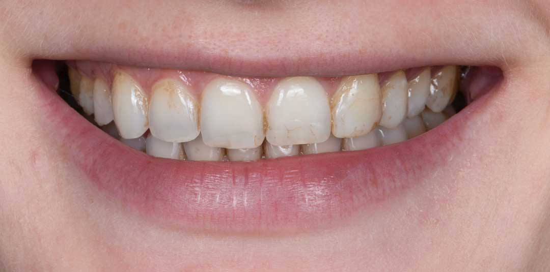 Before in-office teeth whitening treatment