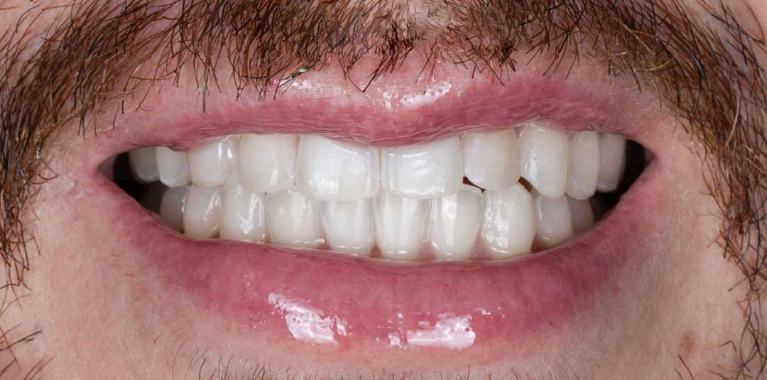 After in-office teeth whitening and Guided Biofilm Therapy