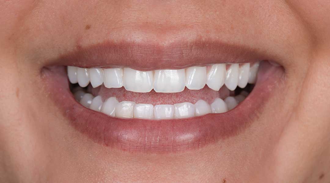 After Guided Biofilm Therapy & Whitening Treatment