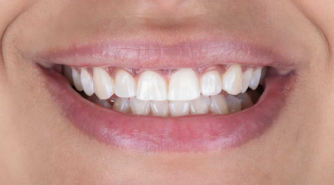 After Guided Biofilm Therapy & Whitening Treatment