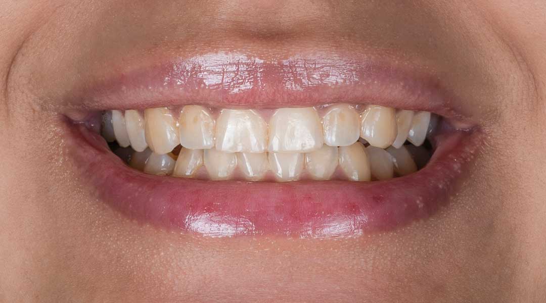 Before Guided Biofilm Therapy & Whitening Treatment