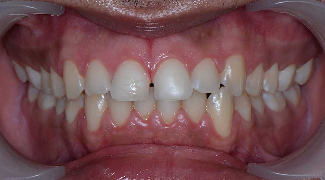 Before Invisalign Treatment