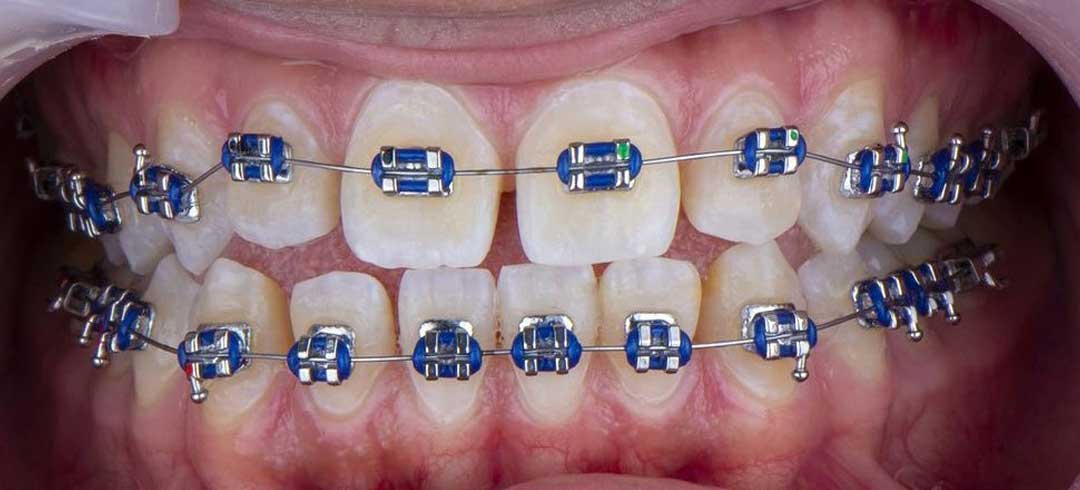 A closeup of the mouth showing a patient with dental braces
