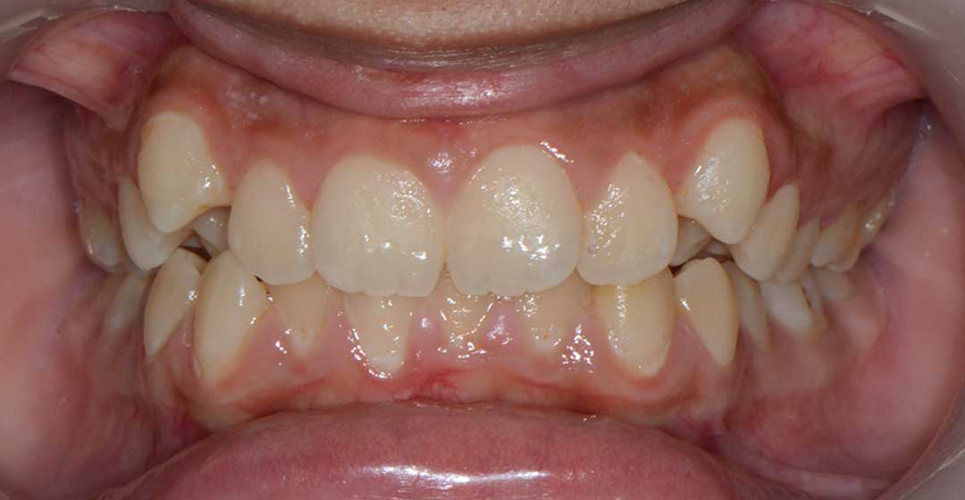 before treatment with braces
