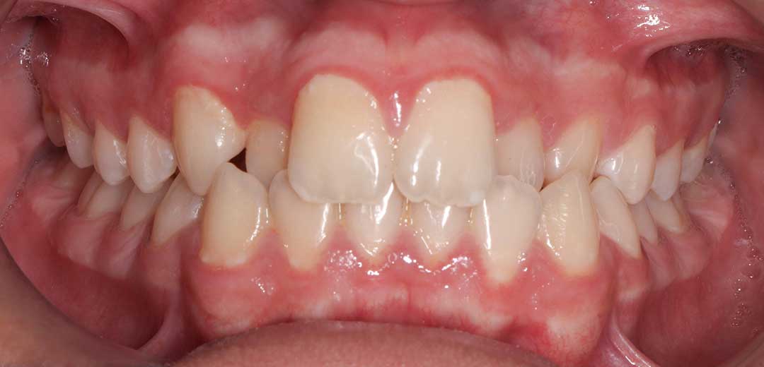 before treatment with braces
