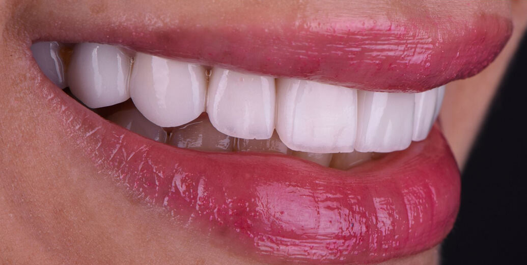Final result with beautiful veneers treatment with Dr. Oussama Alaoui