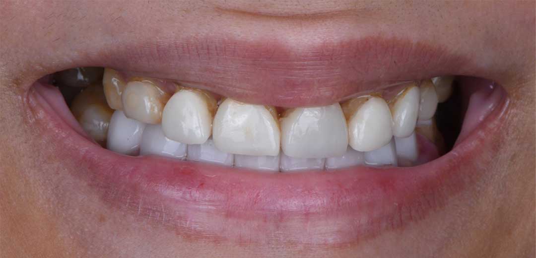 Before Smile Makeover