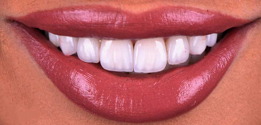 After veneers treatment