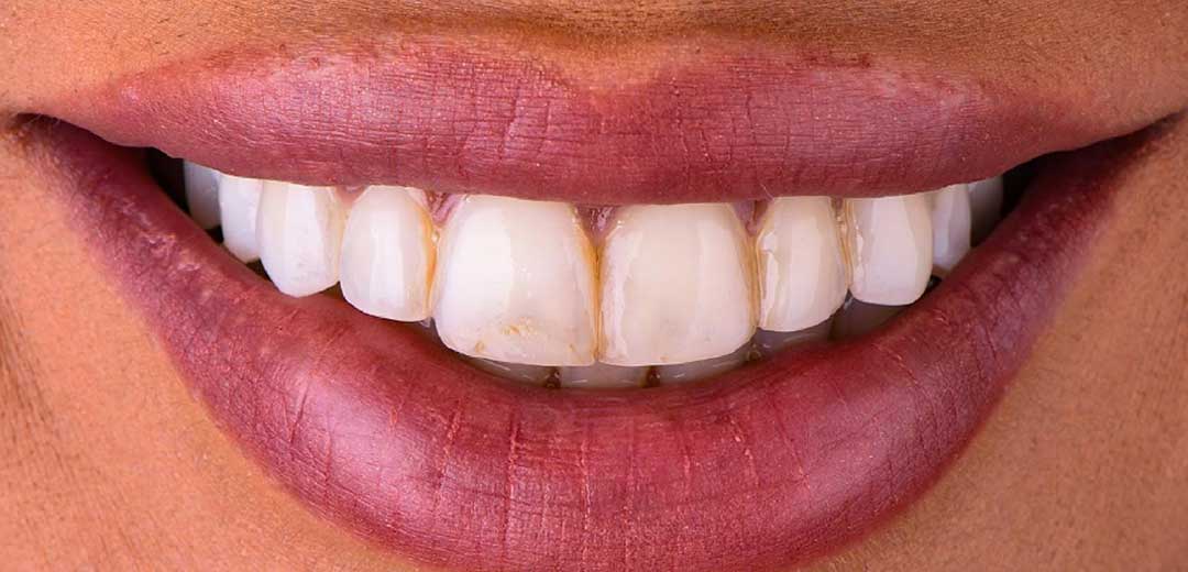 Before veneers treatment