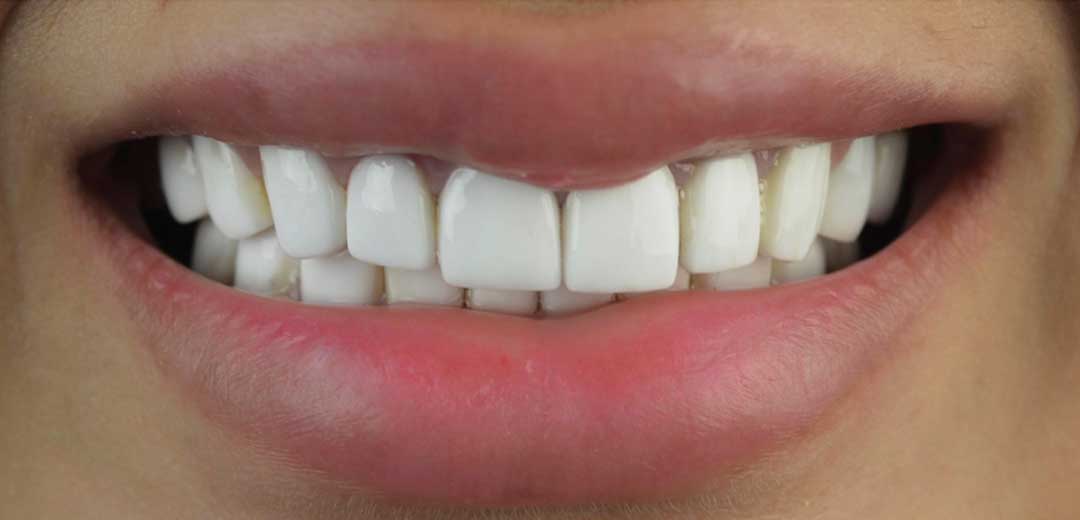 Close-up of a lady’s unnatural, overly white and bulky smile before cosmetic dental treatment with Dr. Roula Kilani at Harmony Medical Center in Dubai