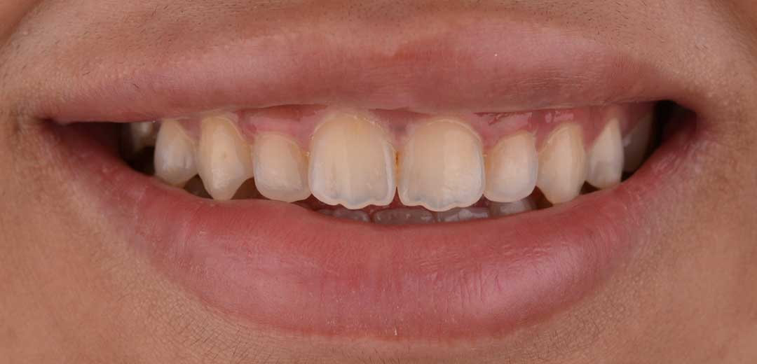 Photo of a smile before smile makeover treatment with Dr. Roula Kilani