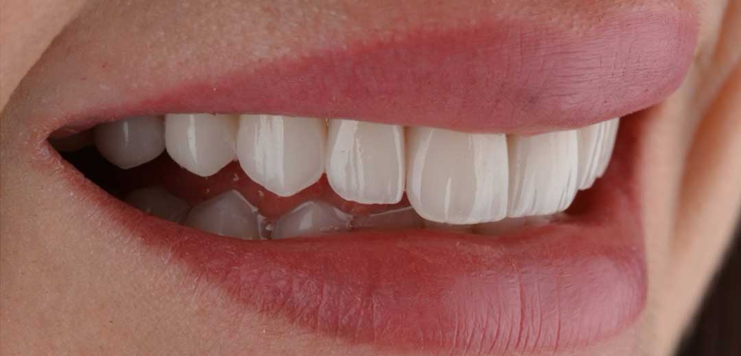 After porcelain veneers