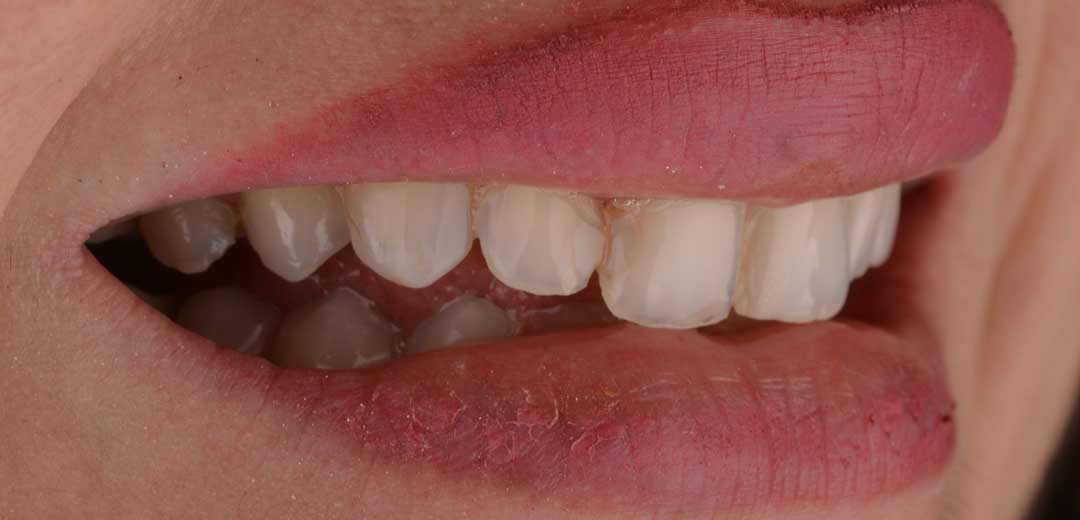 Before porcelain veneers