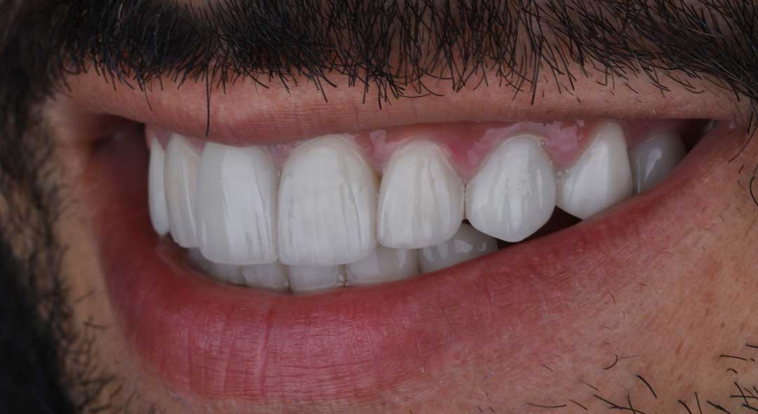 After porcelain veneers