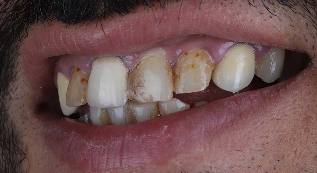 Before porcelain veneers