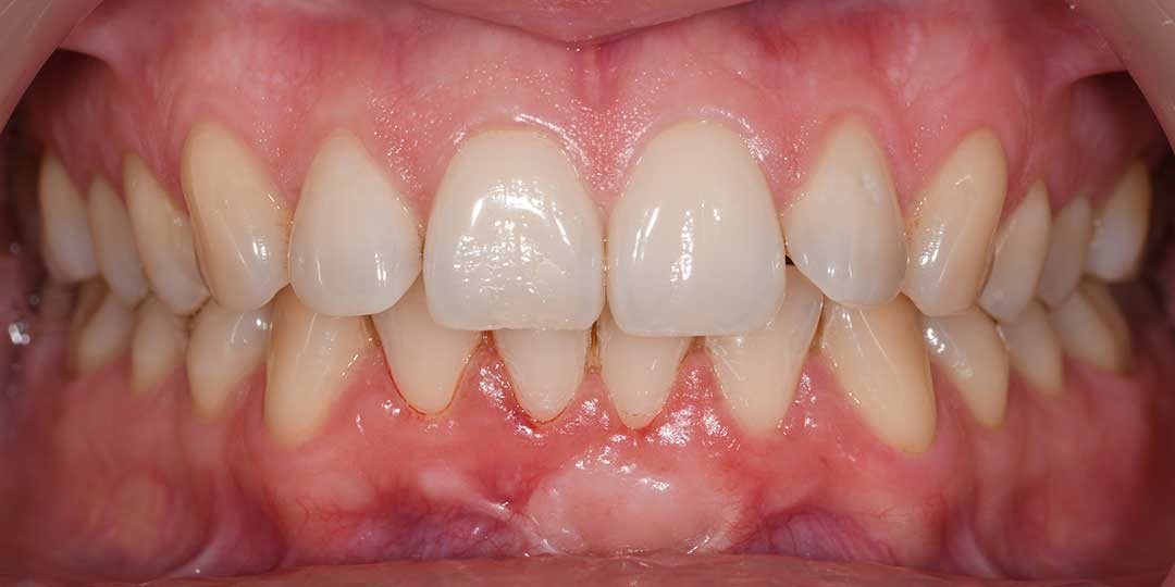 After Gum Recession Treatment