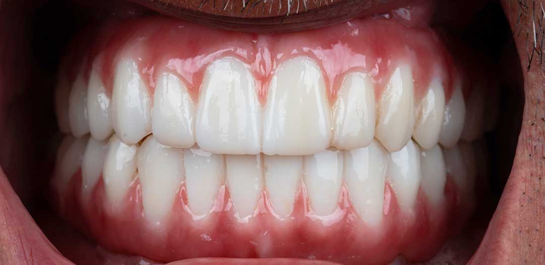After dental implants treatment