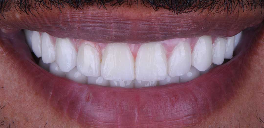 After dental implants