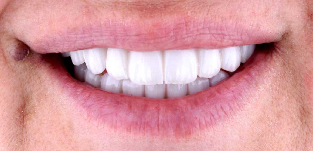 After dental implants