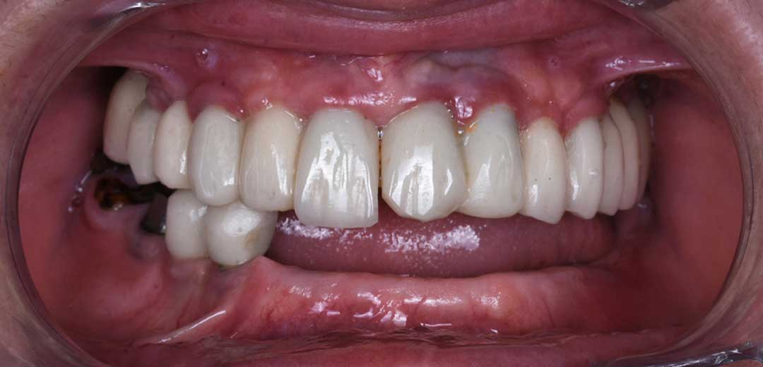 Before dental implants