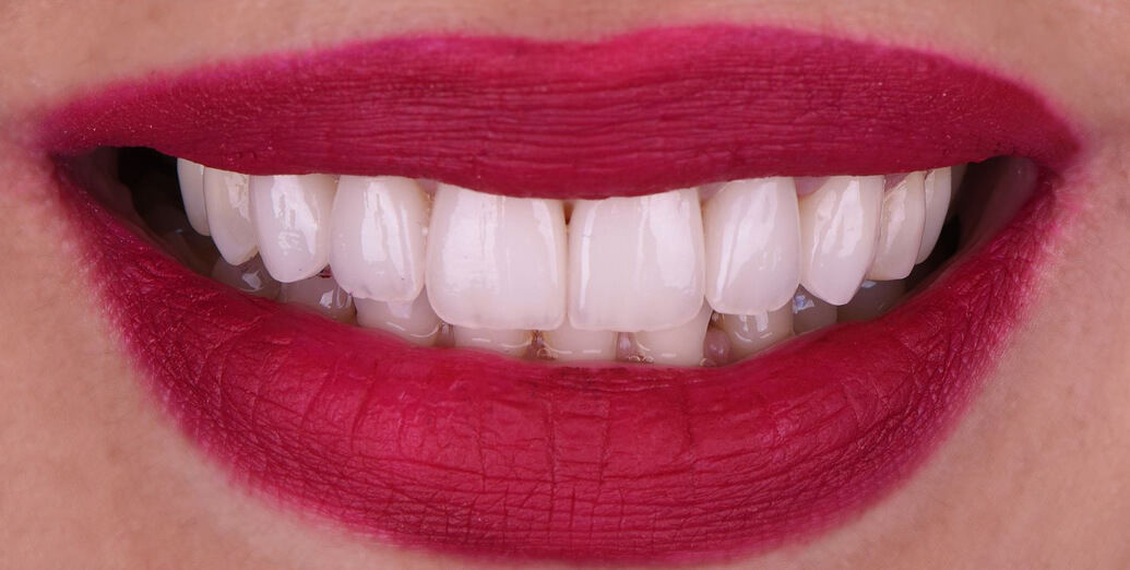After porcelain veneers