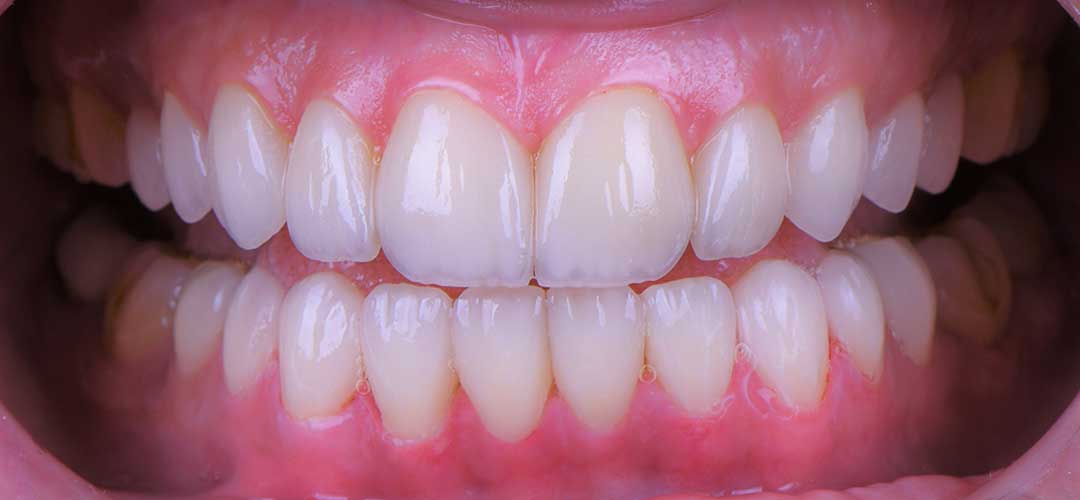 After veneers treatment