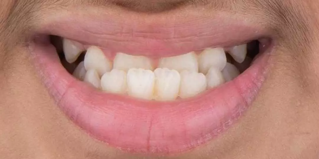 closeup of a child's mouth showing underbite