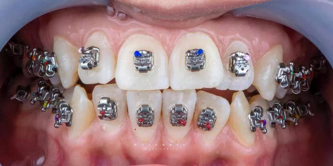 A closeup of a child's mouth showing a crossbite.