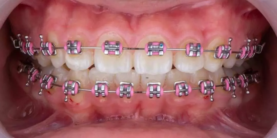 Close-up photo of a child's mouth showing well-aligned teeth after successful treatment for openbite issues.
