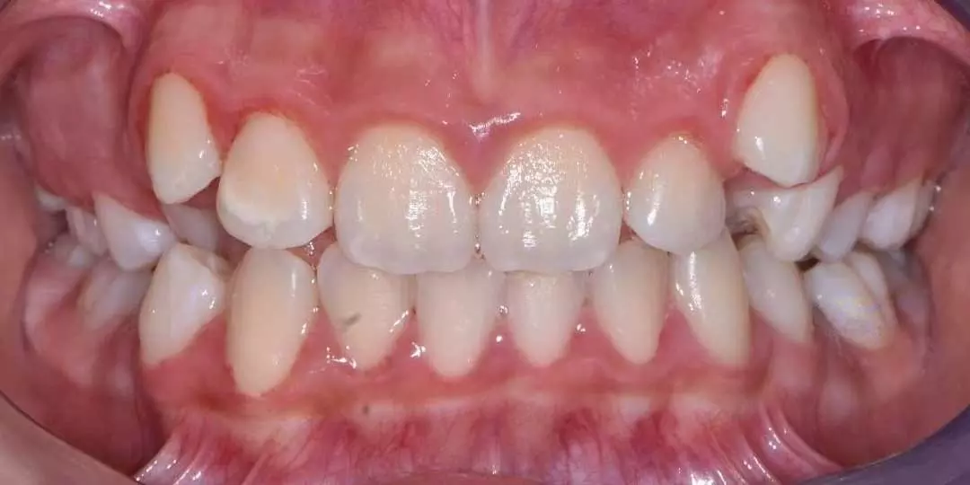 Close-up photo of a child's mouth with an overbite.