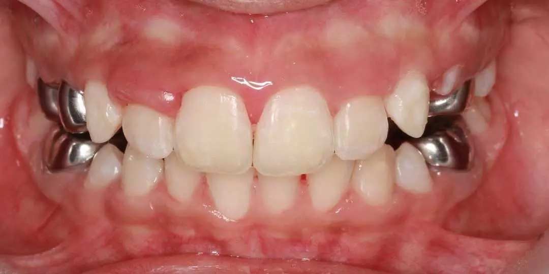 Close-up photo of a child's mouth showing well-aligned teeth after successful treatment for spacing issues.