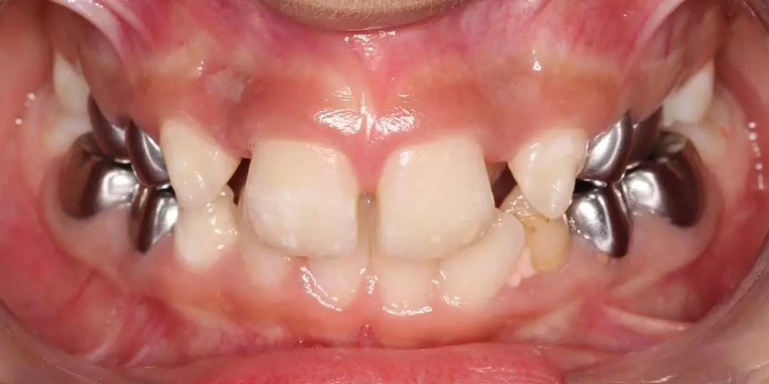 Close-up photo of a child's mouth with crowding.