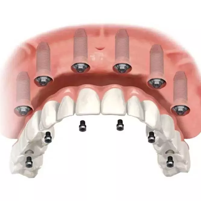 An illustration of all on 6 dental implants