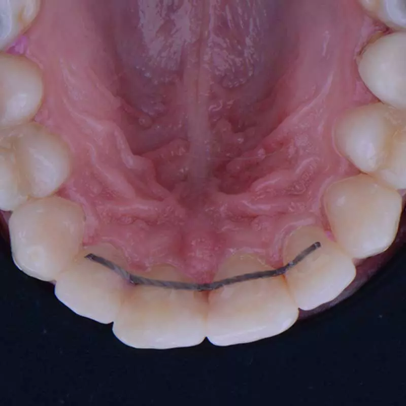 Fixed lingual retainers at Harmony Medical Center