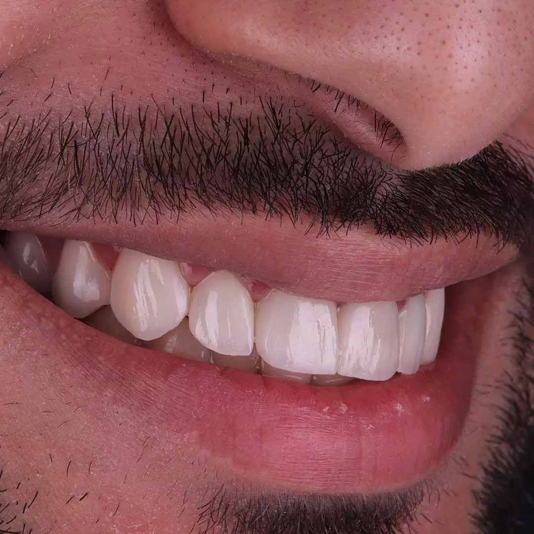 A closeup of a patient's beautiful and clean teeth after Guided Biofilm Therapy at Harmony Medical Center.