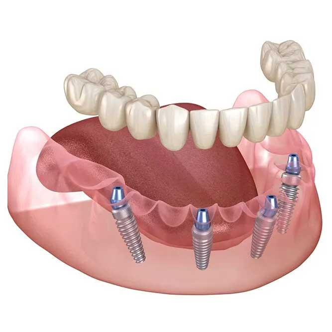 Tooth model showing an All-on-4 dental implant system with four implants supporting a full arch of teeth.