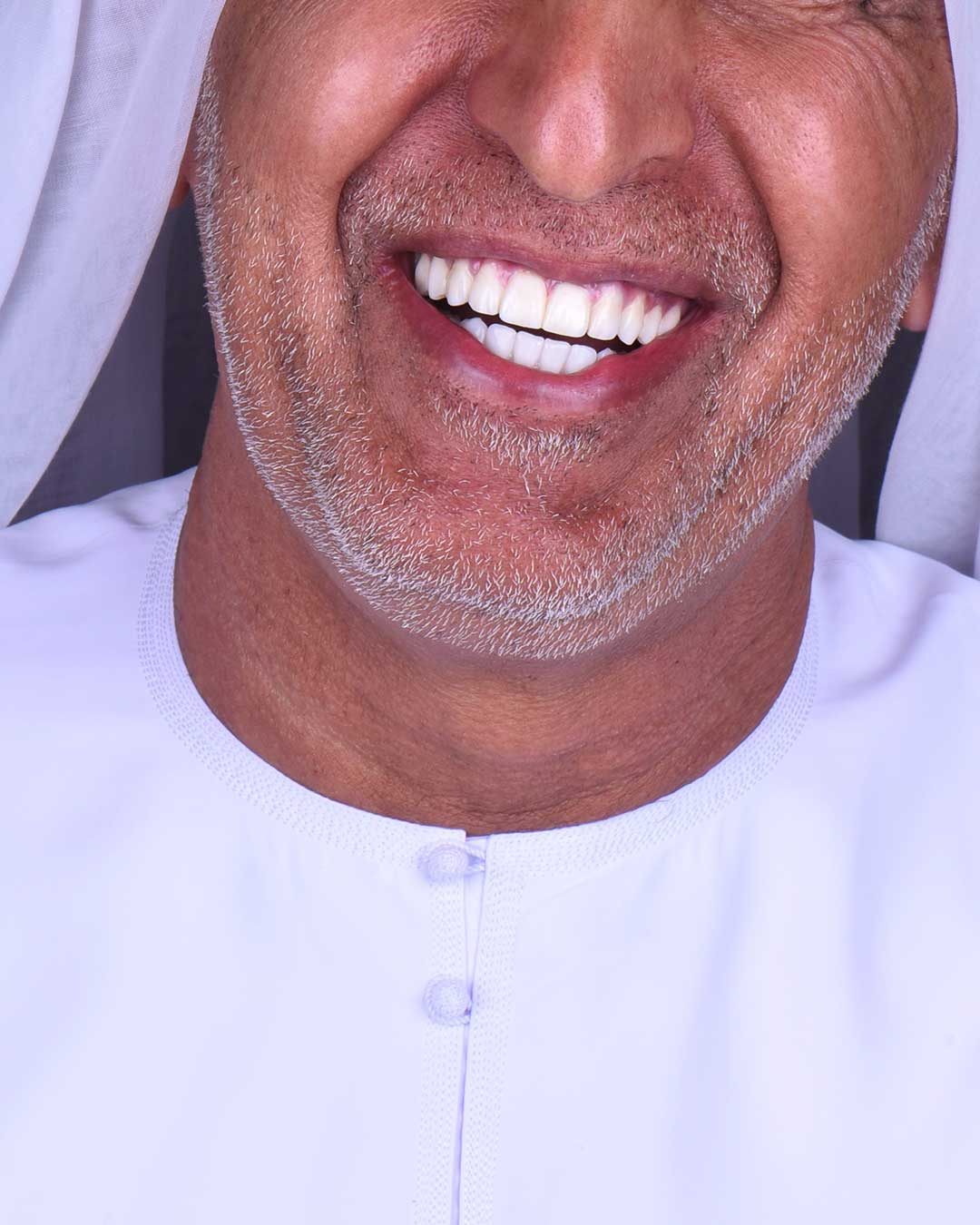 Close-up of the smile of an elderly Emirati patient at Harmony Medical Center after All-on-6 dental implant treatment.