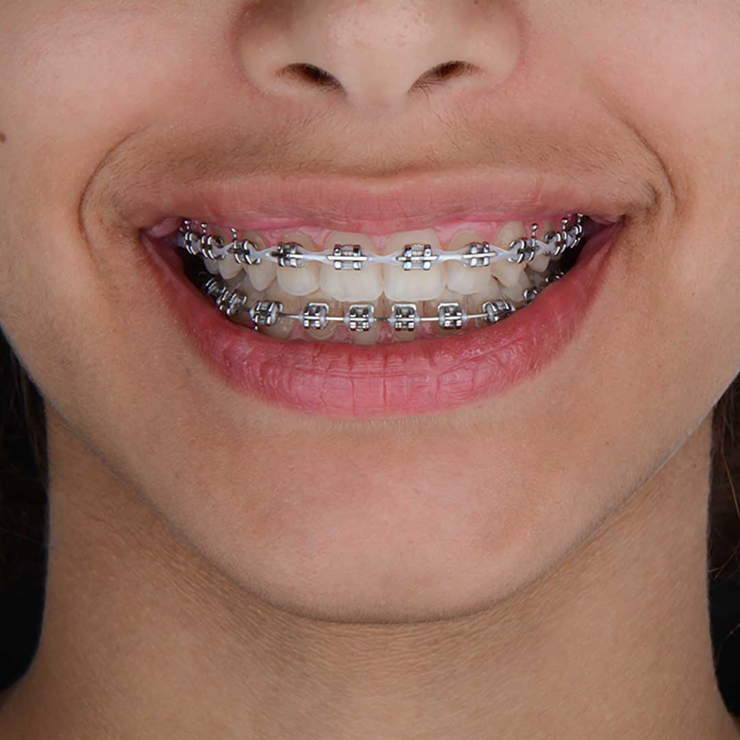A closeup of a patient at Harmony Medical Center wearing braces