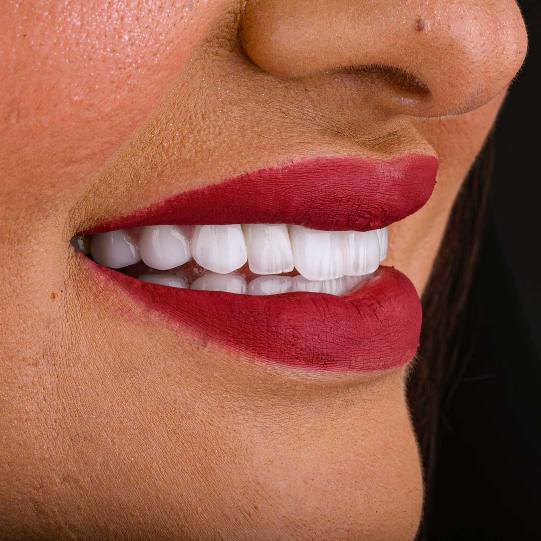 A smiling patient at Harmony Medical Center showcasing her beautiful new veneers.