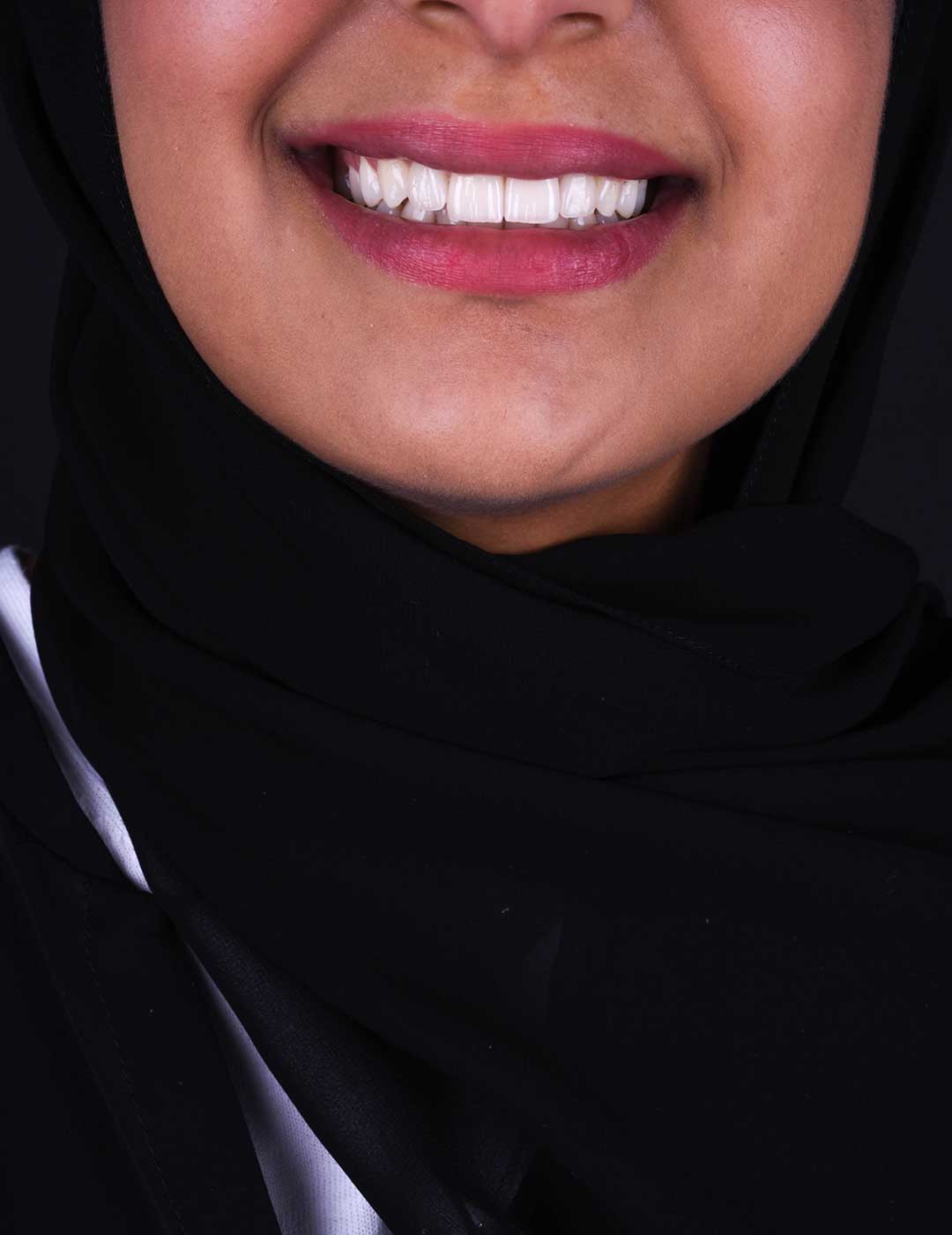 Close-up of a patient's mouth showing a beautiful smile after dental implant treatment at Harmony Medical Center.