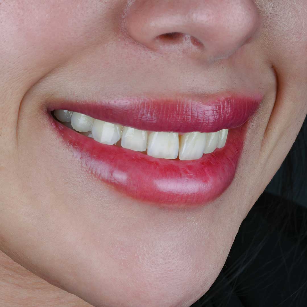 A closeup of a woman's beautiful and clean teeth after treatment at Harmony Medical Center.