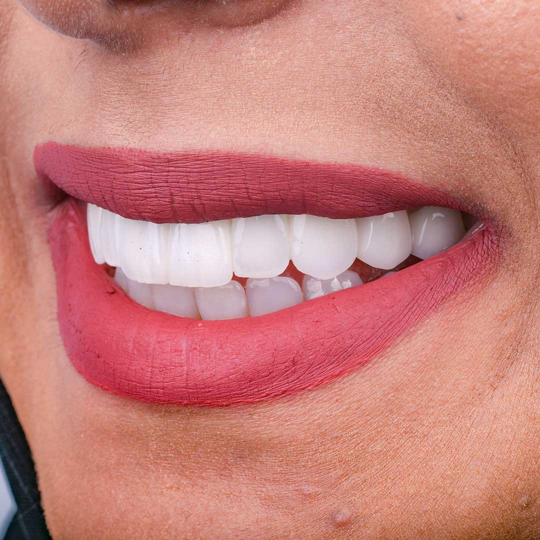 A closeup of a female patient's beautiful and clean teeth after treatment at Harmony Medical Center.